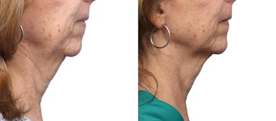Morpheus8® Before & After Gallery - Patient 151304 - Image 1