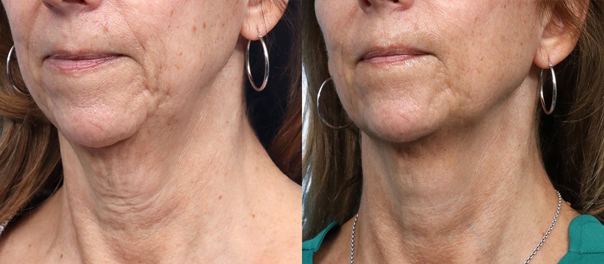 Morpheus8® Before & After Gallery - Patient 151304 - Image 2