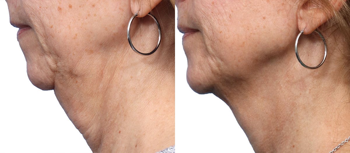 Morpheus8® Before & After Gallery - Patient 151304 - Image 3