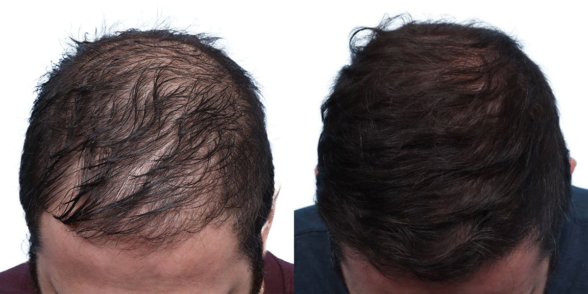 FUE Hair Transplant Before & After Gallery - Patient 140889 - Image 1