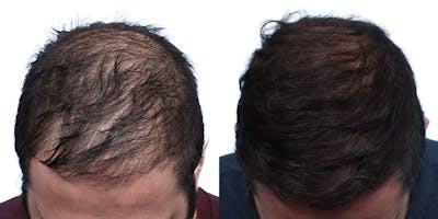 FUE Hair Transplant Before & After Gallery - Patient 140889 - Image 1