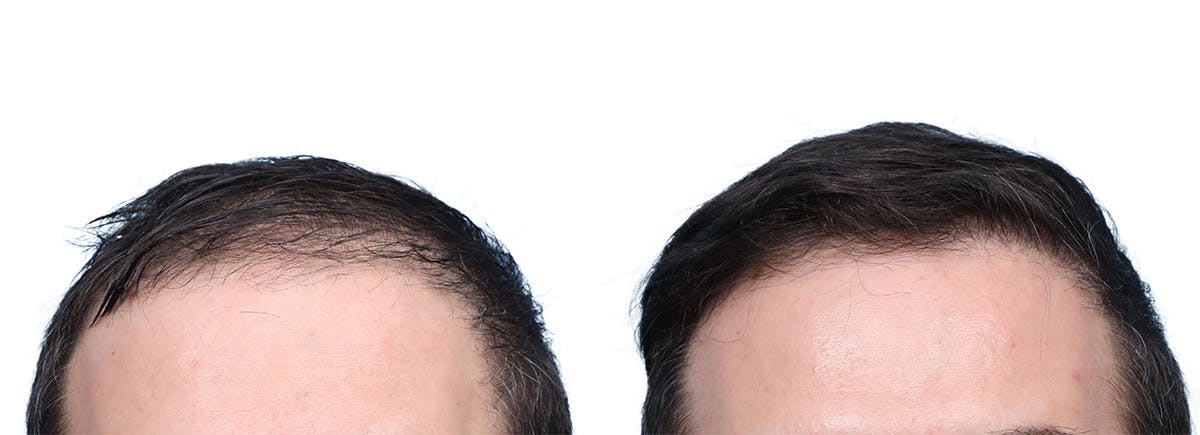 FUE Hair Transplant Before & After Gallery - Patient 140889 - Image 2