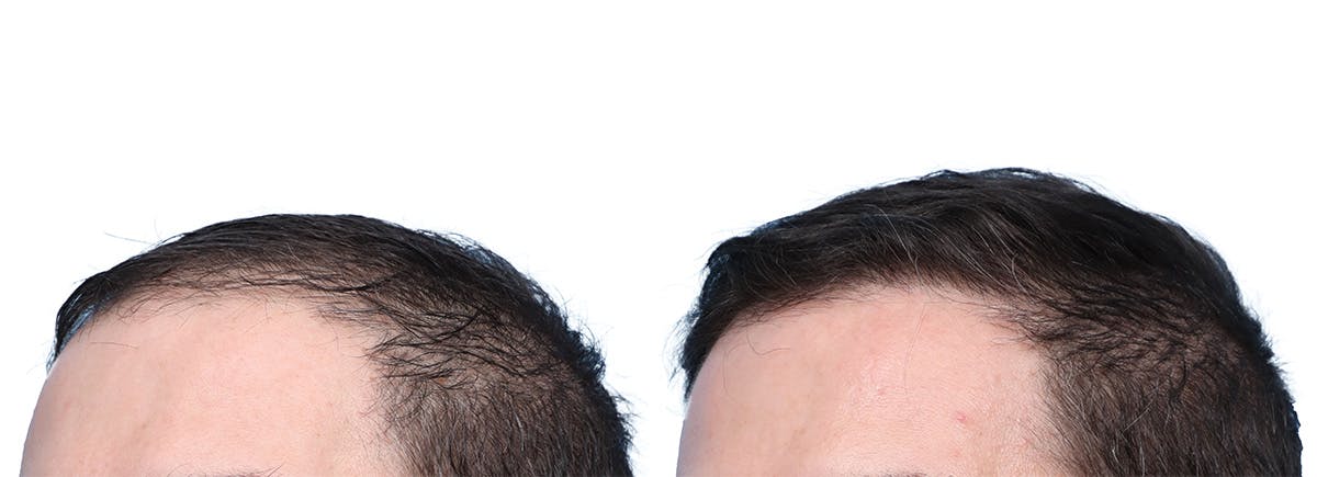 FUE Hair Transplant Before & After Gallery - Patient 140889 - Image 3