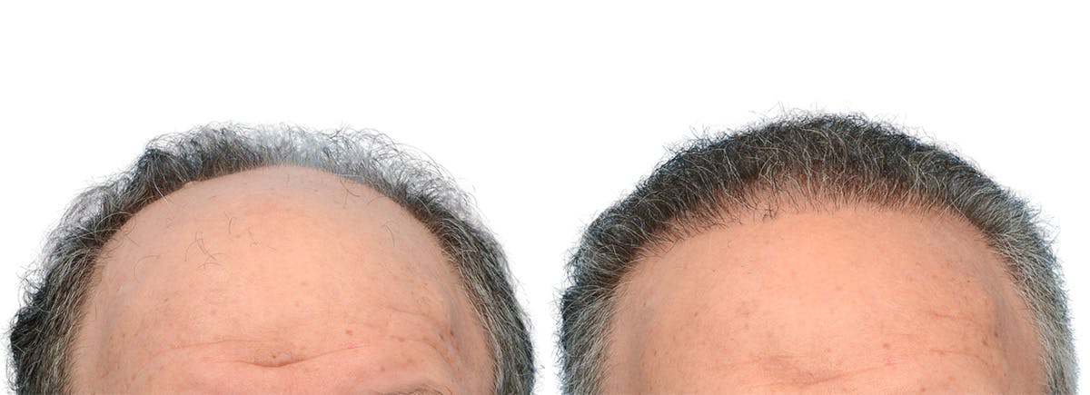 FUE Hair Transplant Before & After Gallery - Patient 718176 - Image 1
