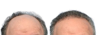 FUE Hair Transplant Before & After Gallery - Patient 718176 - Image 1