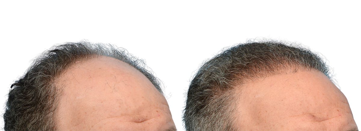 FUE Hair Transplant Before & After Gallery - Patient 718176 - Image 2
