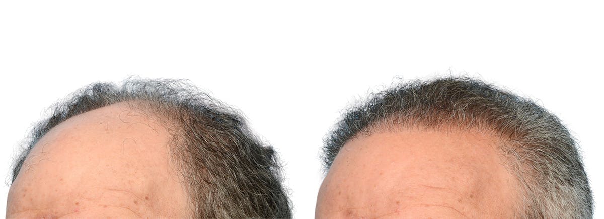 FUE Hair Transplant Before & After Gallery - Patient 718176 - Image 3