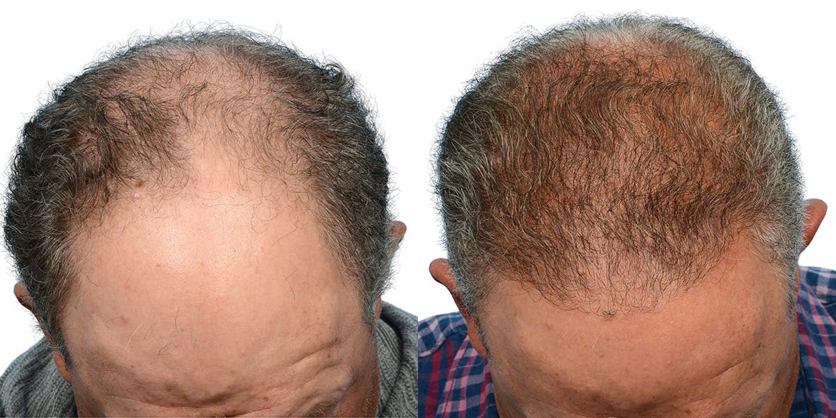 FUE Hair Transplant Before & After Gallery - Patient 718176 - Image 4