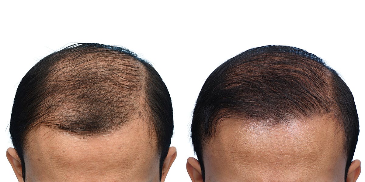 FUE Hair Transplant Before & After Gallery - Patient 153876 - Image 1