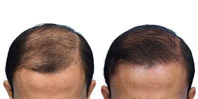 FUE Hair Transplant Before & After Gallery - Patient 153876 - Image 1