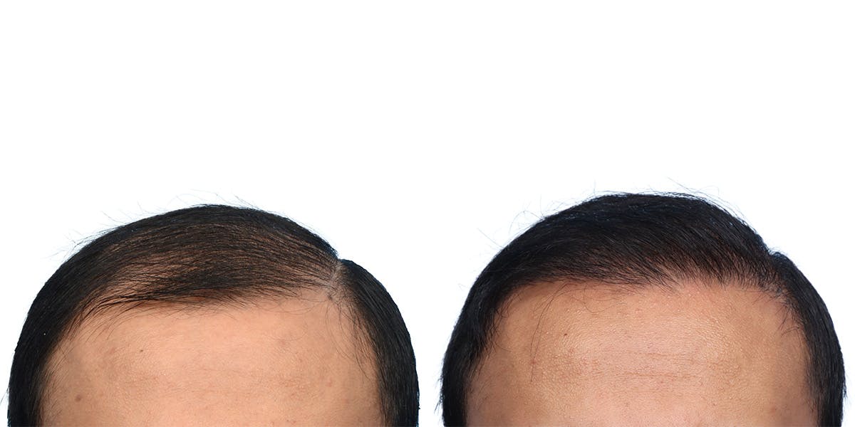 FUE Hair Transplant Before & After Gallery - Patient 153876 - Image 2