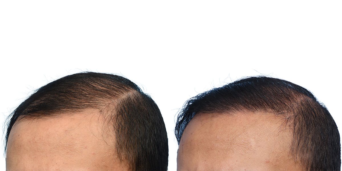FUE Hair Transplant Before & After Gallery - Patient 153876 - Image 3