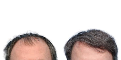 FUE Hair Transplant Before & After Gallery - Patient 146353 - Image 1