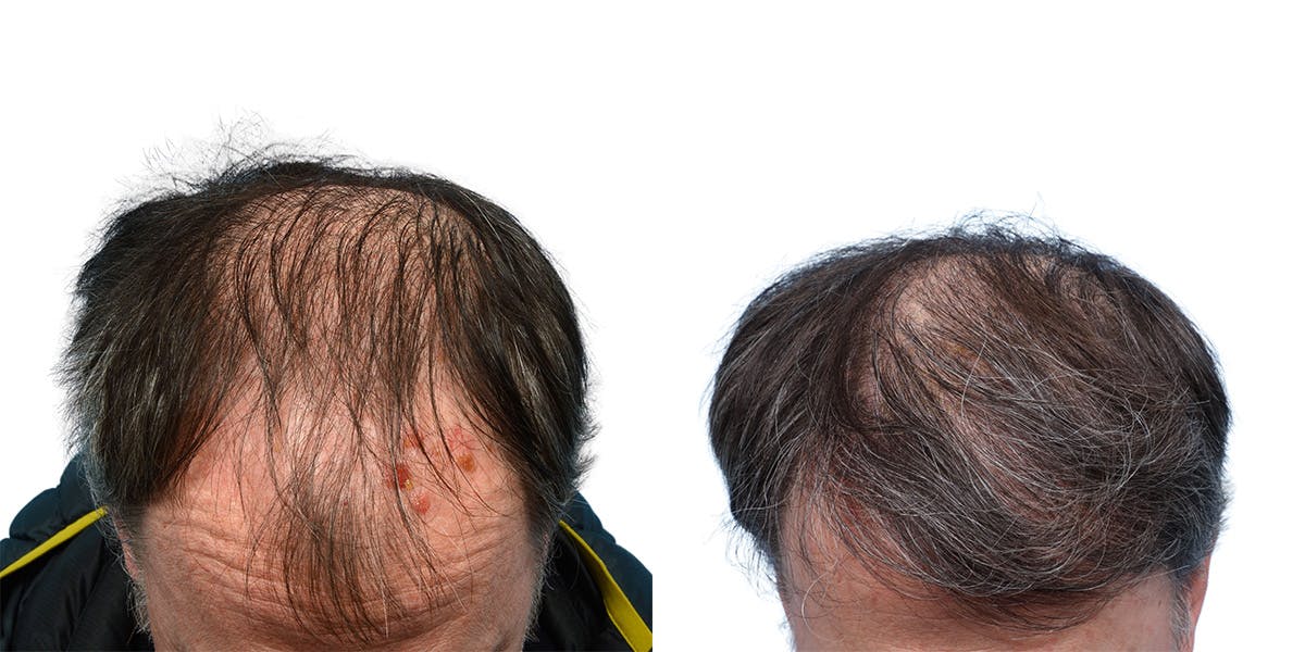 FUE Hair Transplant Before & After Gallery - Patient 146353 - Image 2