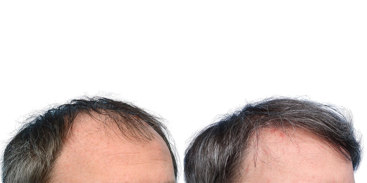 FUE Hair Transplant Before & After Gallery - Patient 146353 - Image 3