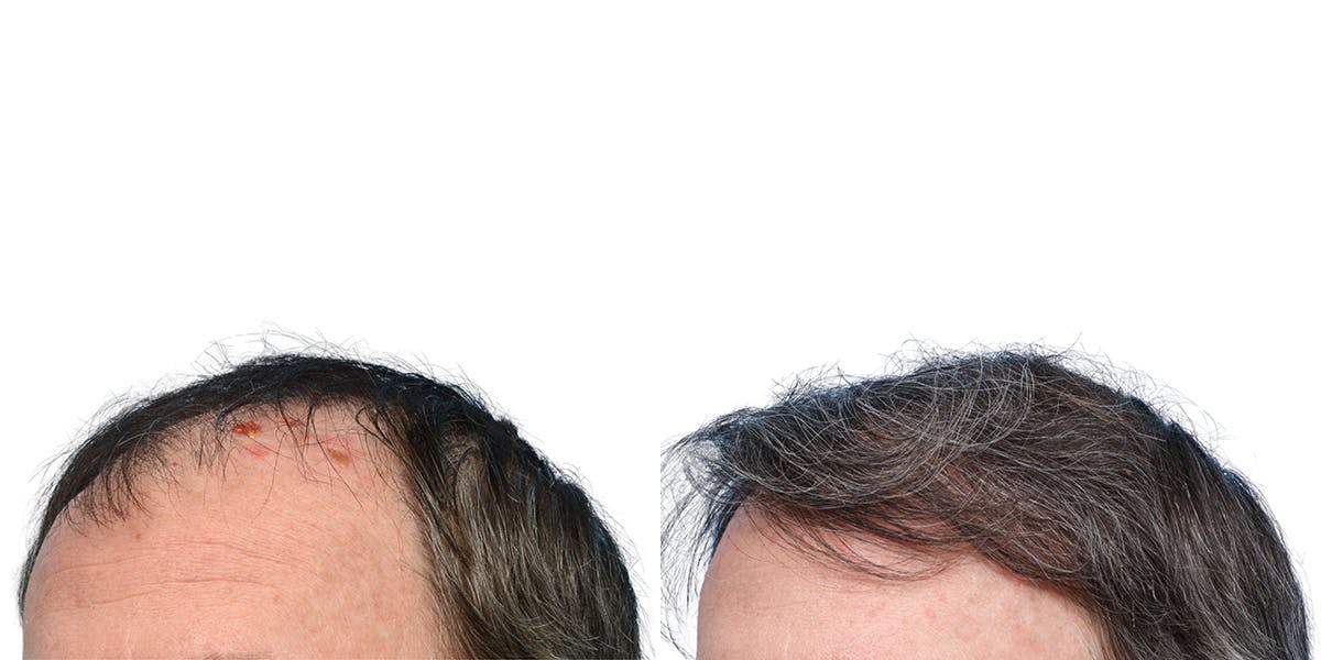 FUE Hair Transplant Before & After Gallery - Patient 146353 - Image 4
