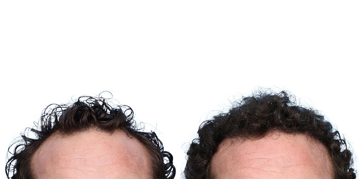FUE Hair Transplant Before & After Gallery - Patient 236765 - Image 1