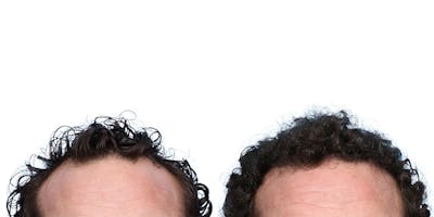 FUE Hair Transplant Before & After Gallery - Patient 236765 - Image 1