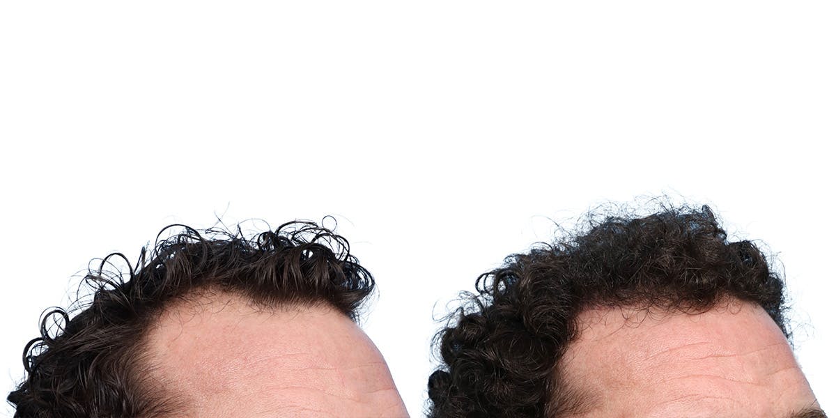 FUE Hair Transplant Before & After Gallery - Patient 236765 - Image 2