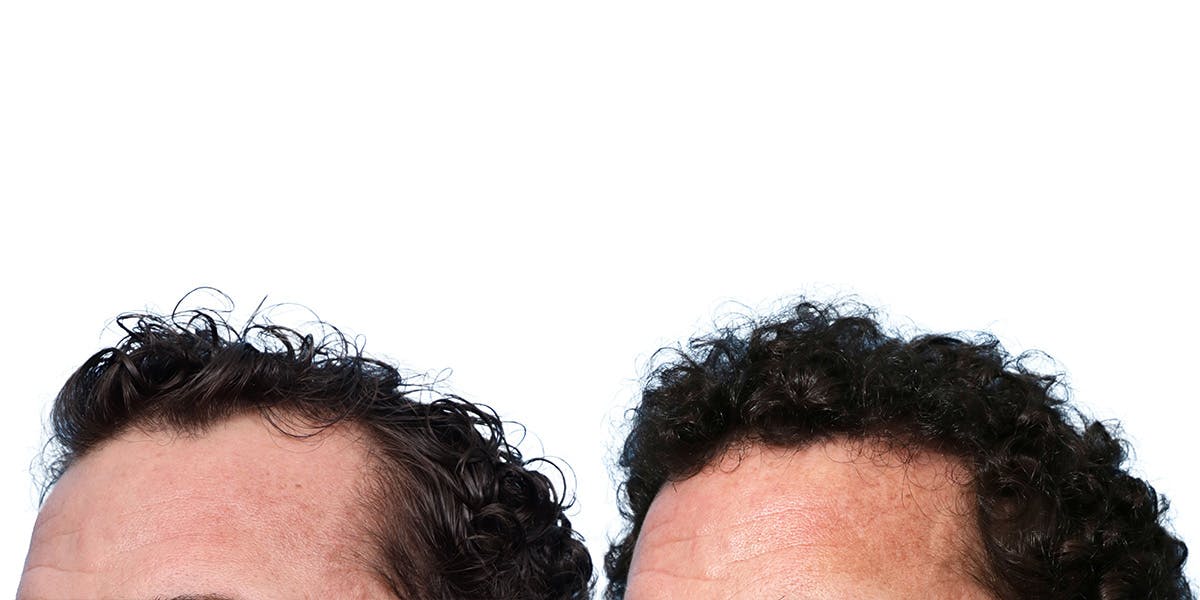 FUE Hair Transplant Before & After Gallery - Patient 236765 - Image 3