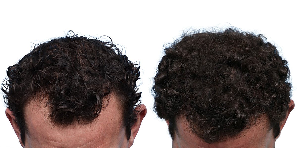 FUE Hair Transplant Before & After Gallery - Patient 236765 - Image 4