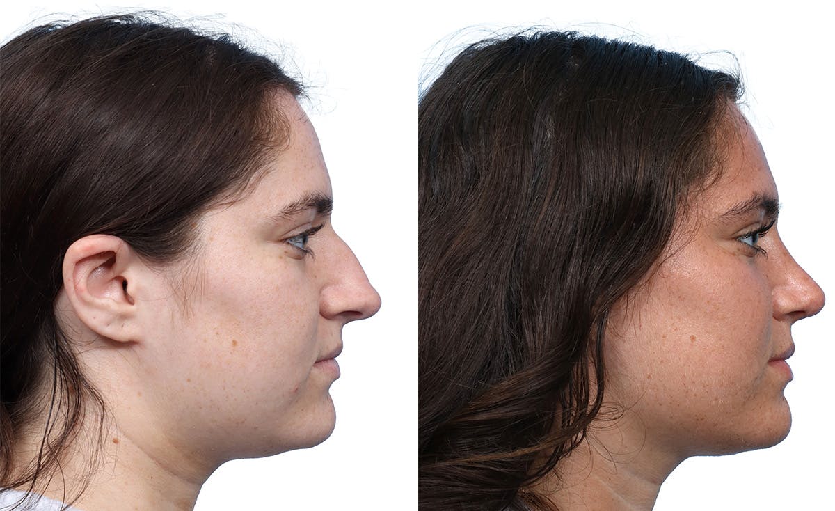 Rhinoplasty Before & After Gallery - Patient 324173 - Image 1