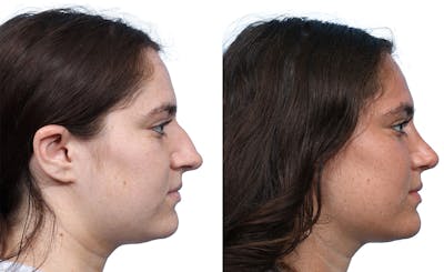 Rhinoplasty Before & After Gallery - Patient 324173 - Image 1