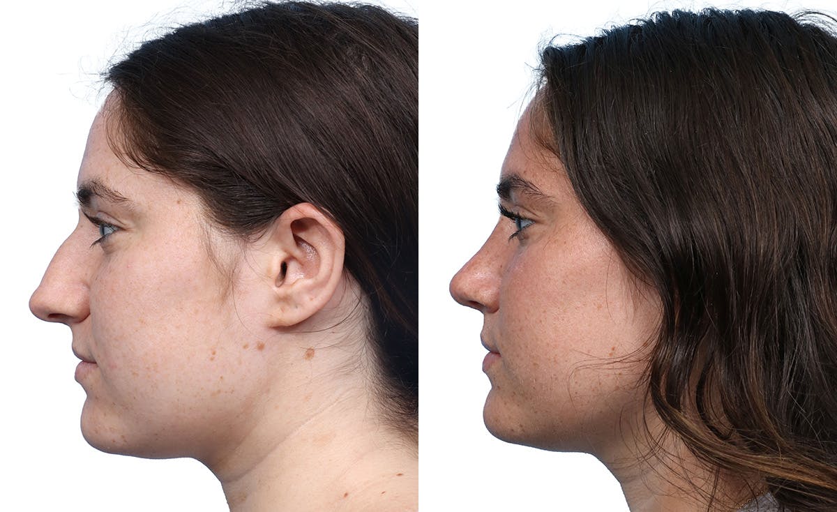 Rhinoplasty Before & After Gallery - Patient 324173 - Image 2