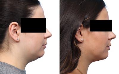 Submental Liposuction Before & After Gallery - Patient 487749 - Image 1