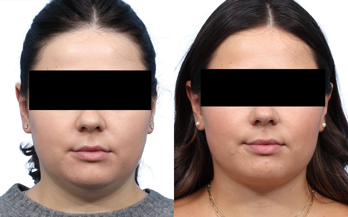 Submental Liposuction Before & After Gallery - Patient 487749 - Image 2