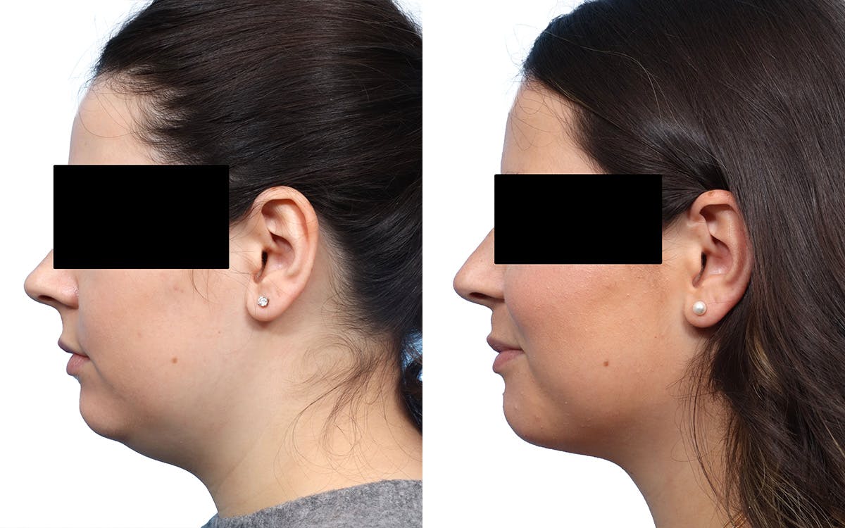Submental Liposuction Before & After Gallery - Patient 487749 - Image 3