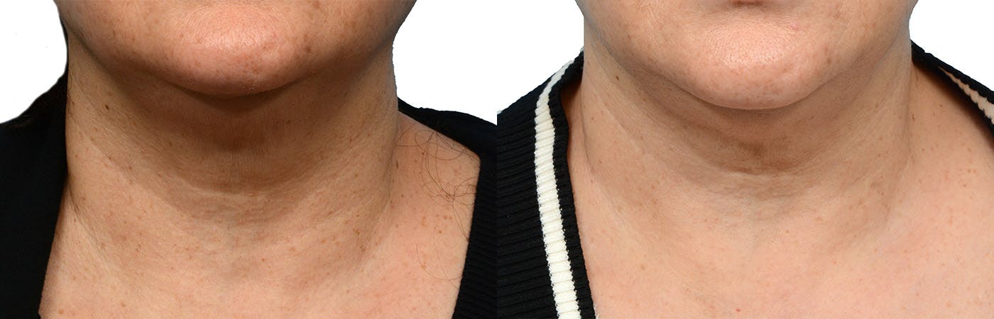 Morpheus8® Before & After Gallery - Patient 388663 - Image 1