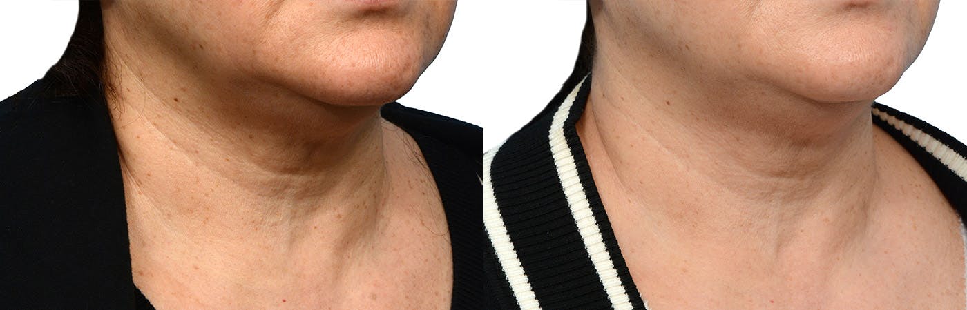 Morpheus8® Before & After Gallery - Patient 388663 - Image 2