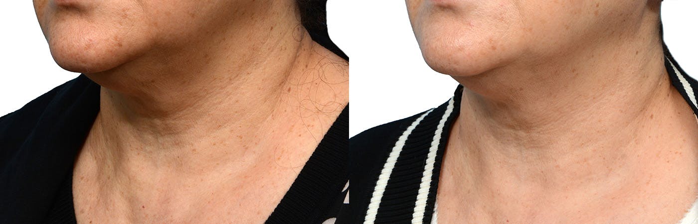 Morpheus8® Before & After Gallery - Patient 388663 - Image 3