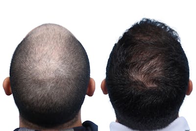 FUE Hair Transplant Before & After Gallery - Patient 130907 - Image 1