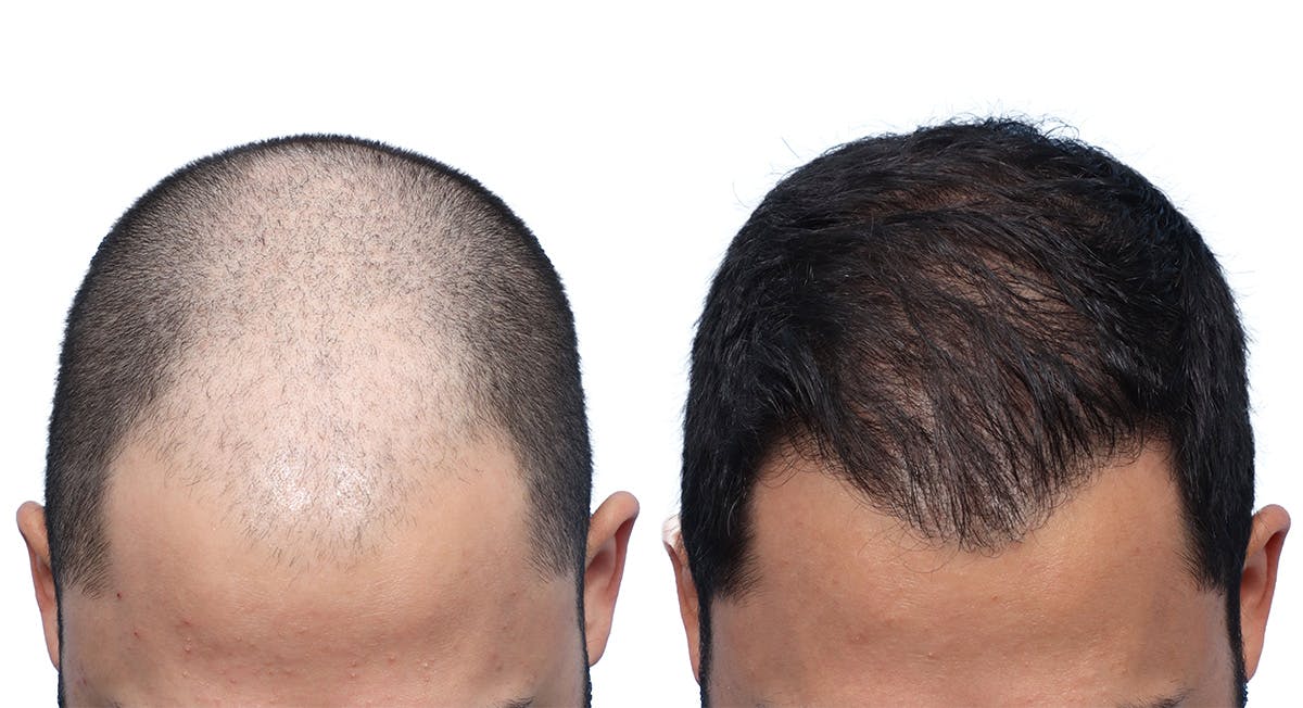 FUE Hair Transplant Before & After Gallery - Patient 130907 - Image 2