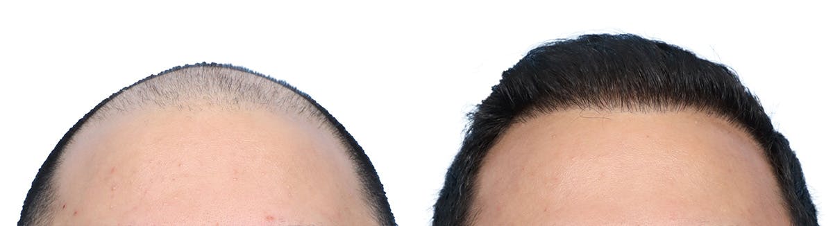 FUE Hair Transplant Before & After Gallery - Patient 130907 - Image 3