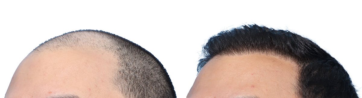 FUE Hair Transplant Before & After Gallery - Patient 130907 - Image 4