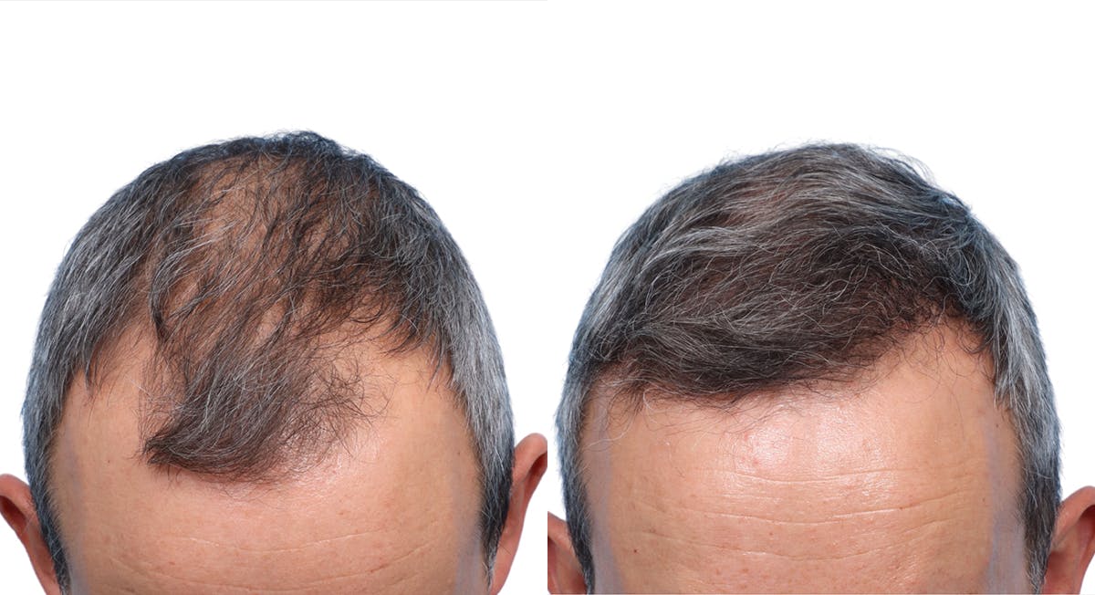FUE Hair Transplant Before & After Gallery - Patient 428660 - Image 2