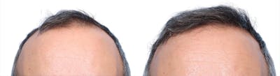 FUE Hair Transplant Before & After Gallery - Patient 428660 - Image 1