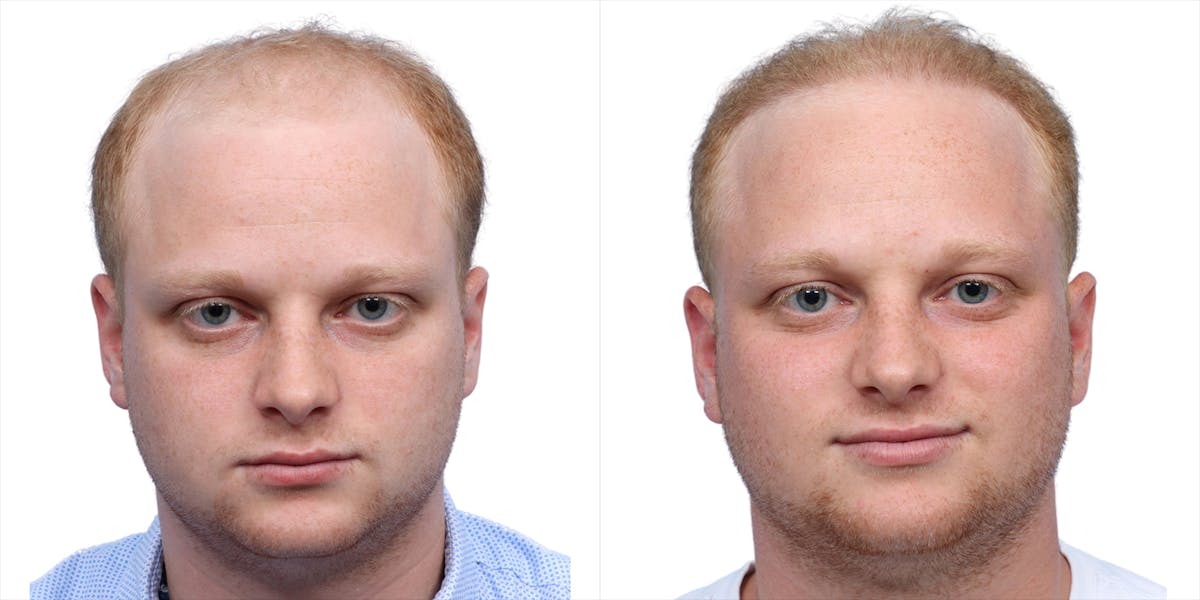 FUE Hair Transplant Before & After Gallery - Patient 243692 - Image 1