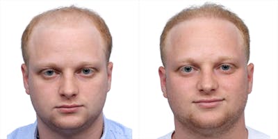 FUE Hair Transplant Before & After Gallery - Patient 243692 - Image 1