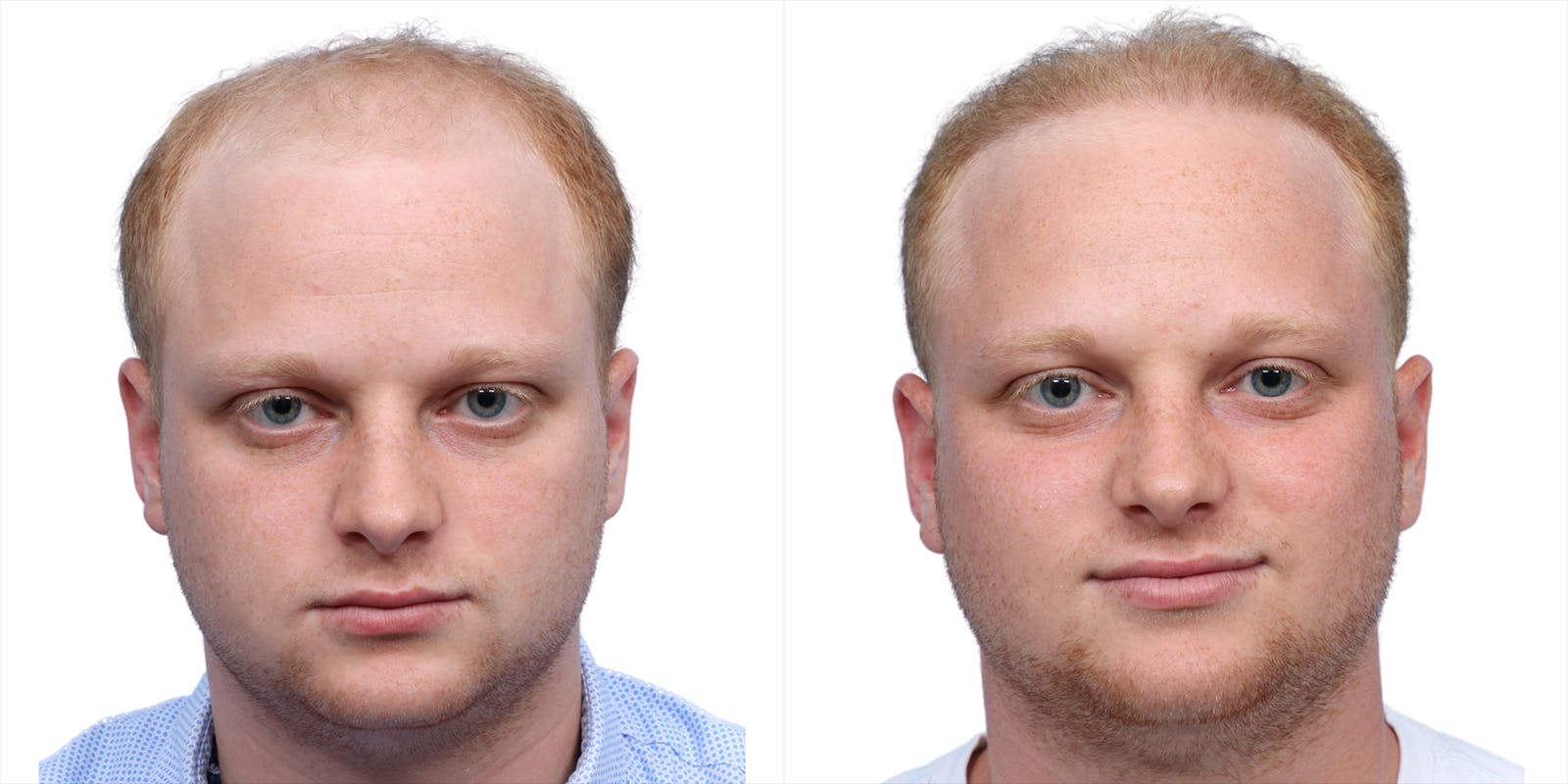 FUE Hair Transplant Before & After Gallery - Patient 243692 - Image 1
