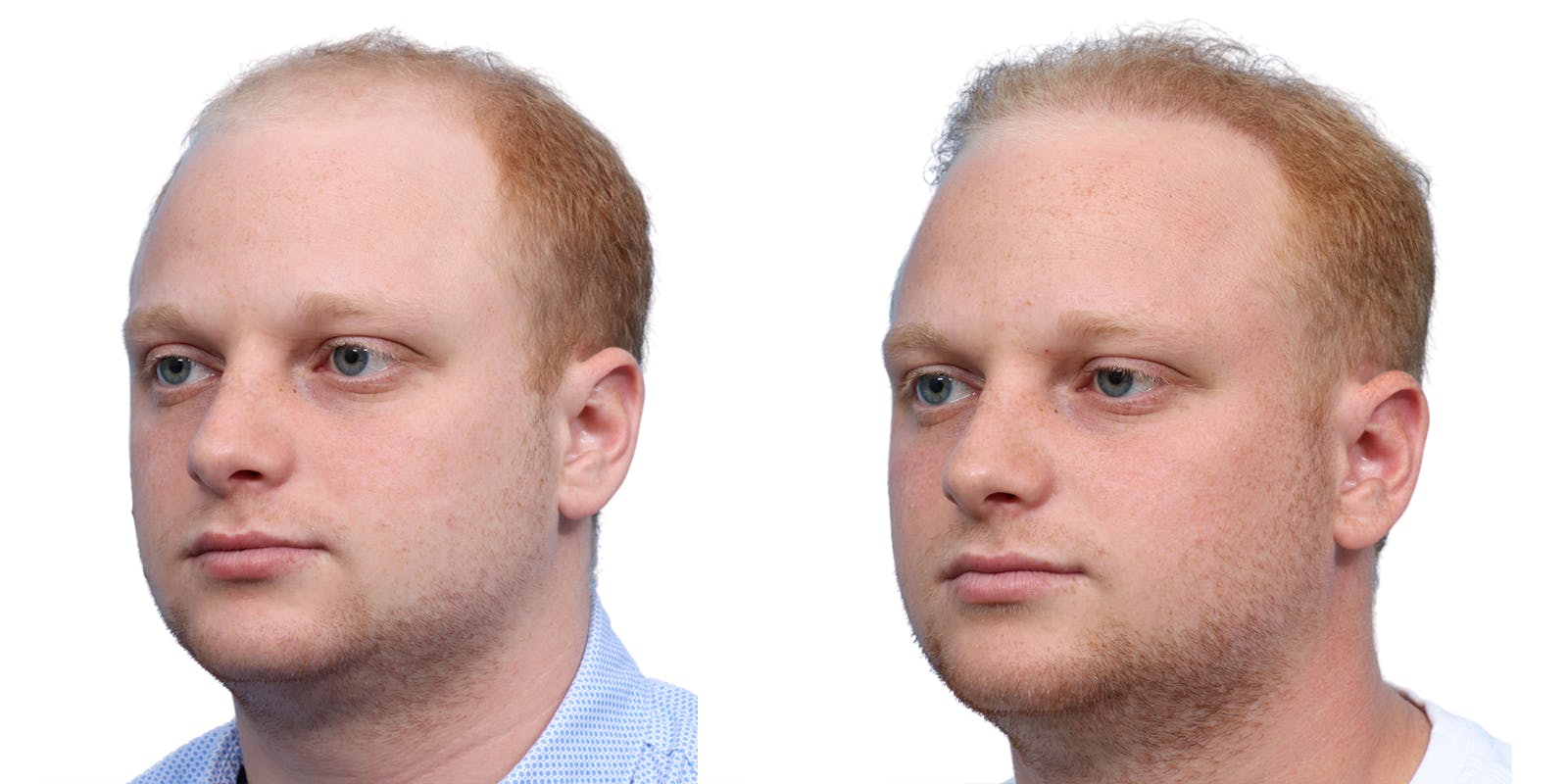 FUE Hair Transplant Before & After Gallery - Patient 243692 - Image 3