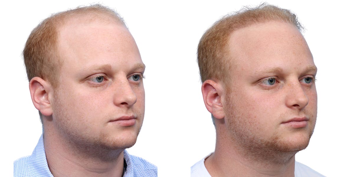 FUE Hair Transplant Before & After Gallery - Patient 243692 - Image 2