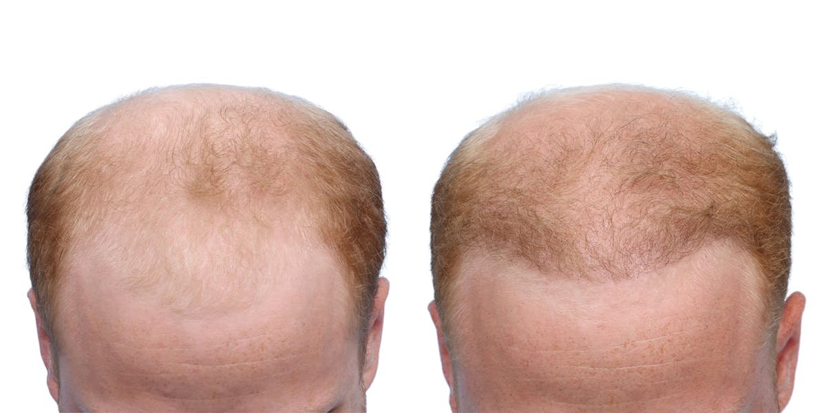 FUE Hair Transplant Before & After Gallery - Patient 243692 - Image 4