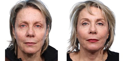 Facelift Before & After Gallery - Patient 344529 - Image 1