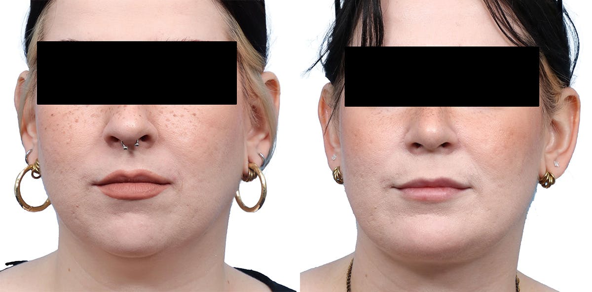 Chin Augmentation Before & After Gallery - Patient 167743 - Image 3