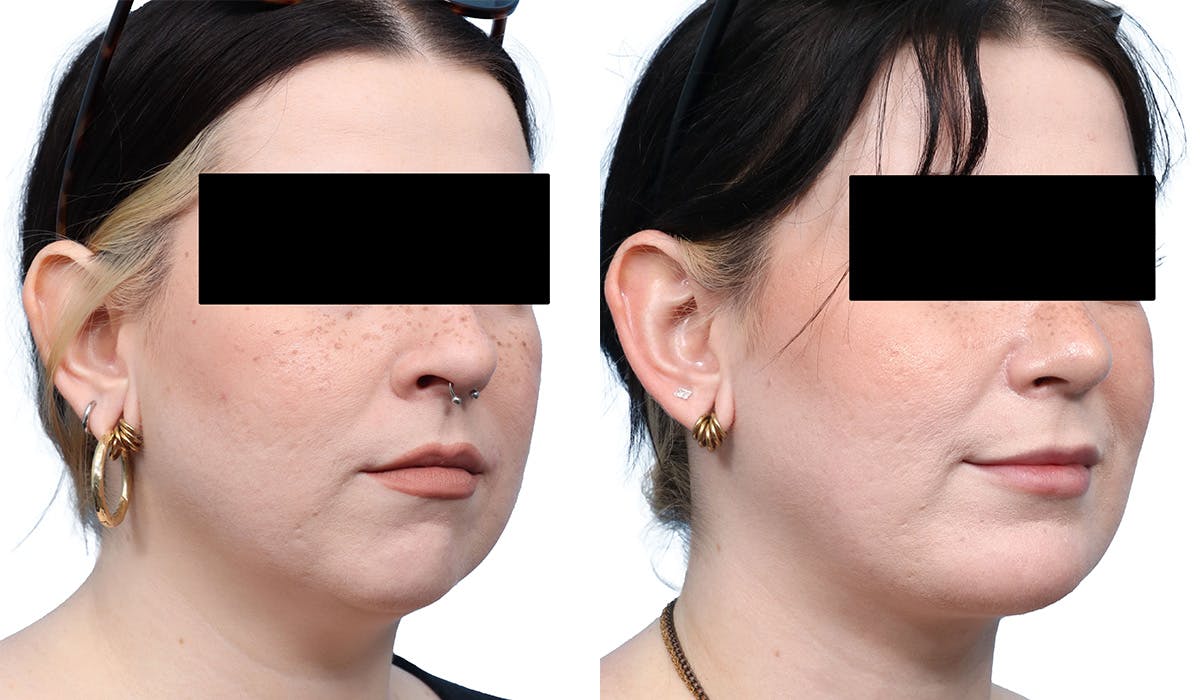 Chin Augmentation Before & After Gallery - Patient 167743 - Image 2