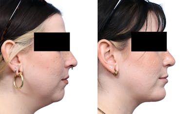 Chin Augmentation Before & After Gallery - Patient 167743 - Image 1